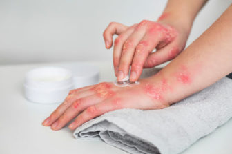 Eczema Treatments