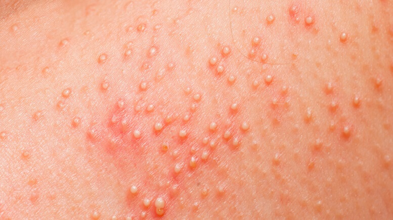Atopic Dermatitis: Causes, Symptoms and Treatments