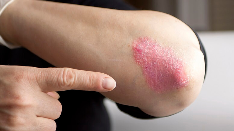 Natural Psoriasis Treatments to Try