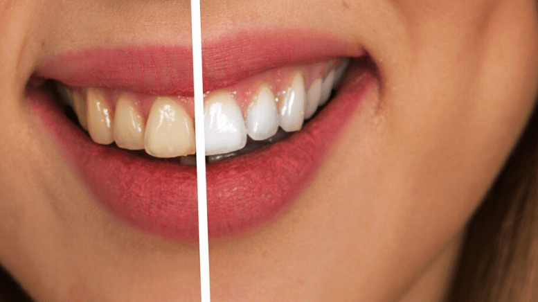 Want Whiter Teeth? Try These 3 Teeth Whitening Produ...